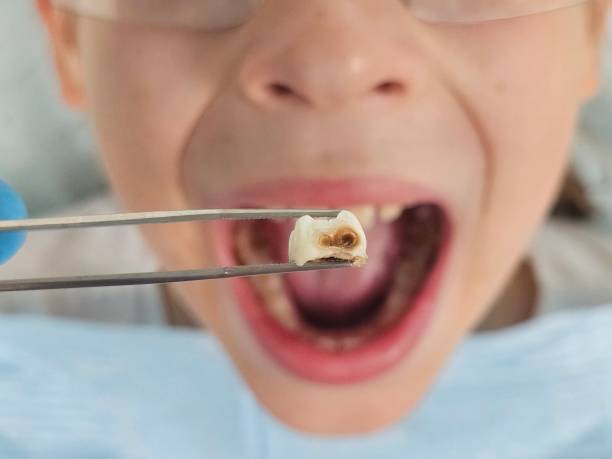Best Emergency Wisdom Tooth Extraction in Carson City, NV